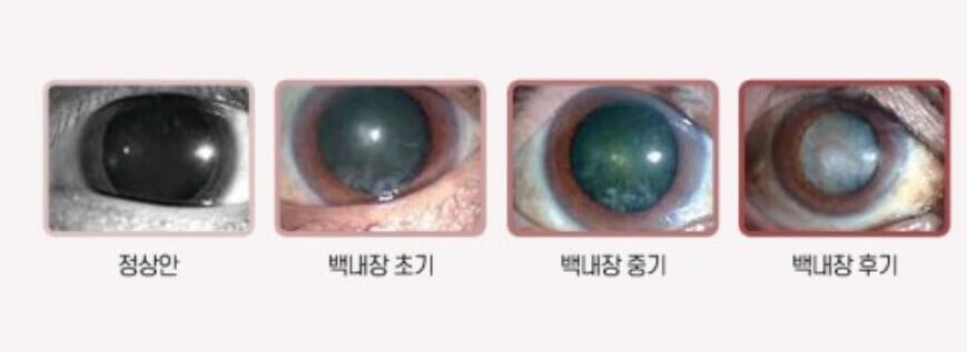 백내장 수정체 변화과정