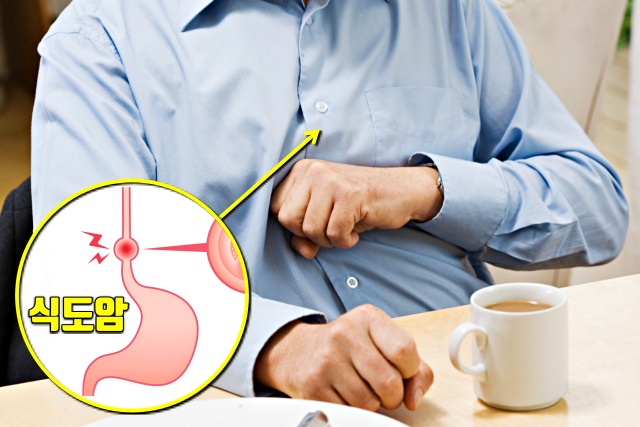 속쓰림, 놓치기 쉬운 암 증상 7가지, 식도암 증상 원인, 건강, 팁줌 매일꿀정보