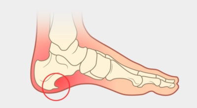 족저근막염 이미지