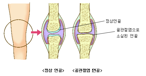 퇴행성 관절염