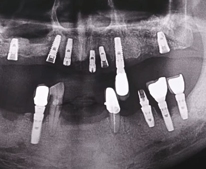 임플란트 주위염 ; 증상&amp;#44; 원인&amp;#44; 예방 및 관리방법 알아보기(재수술&amp;#44; 부작용&amp;#44; 재식립)