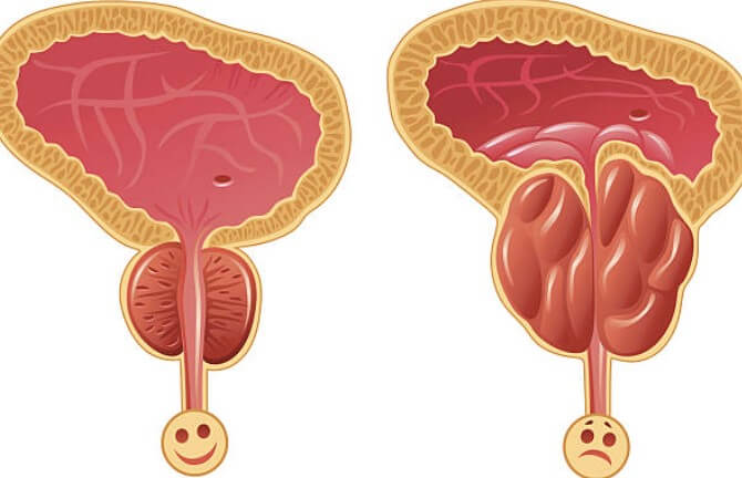 전립선비대증약복용