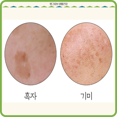 흑자와 기미의 차이