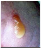 포도상 구균 감염 치료법