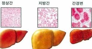 간수치가 올라가는 이유