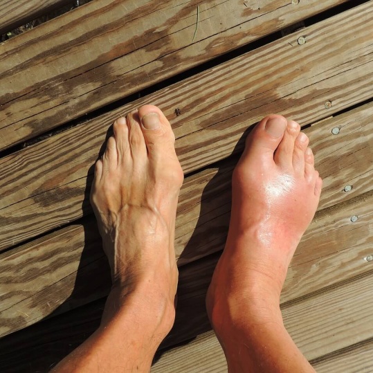 왼쪽에-비해-붓기있는-오른쪽-발-사진