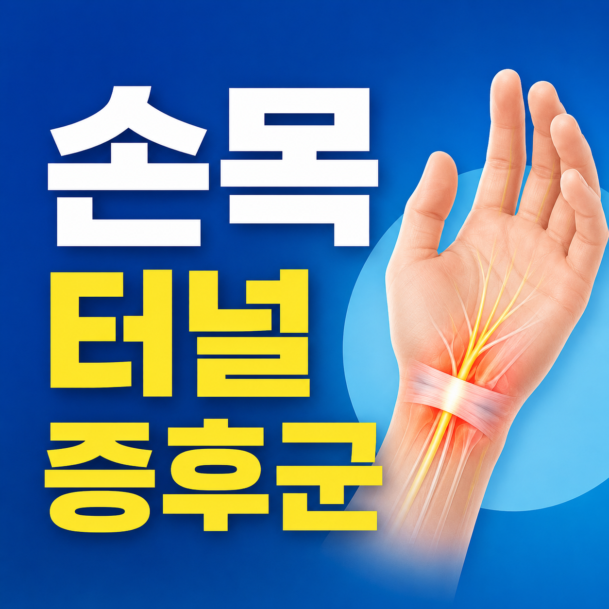 손목 터널 증후군