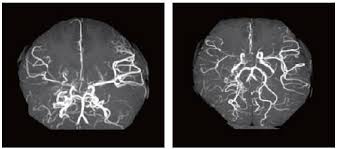 모야모야병 유전 증상 원인 치료 수술
