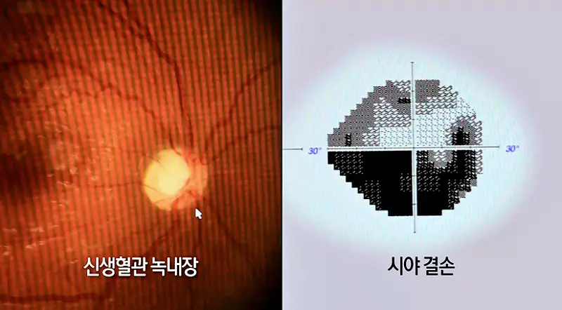 KBS 생로병사의 비밀 833회 높은 안압 녹내장 자각 증상 늦어 내 눈을 지킬 방법 오늘방송 다시보기 정보