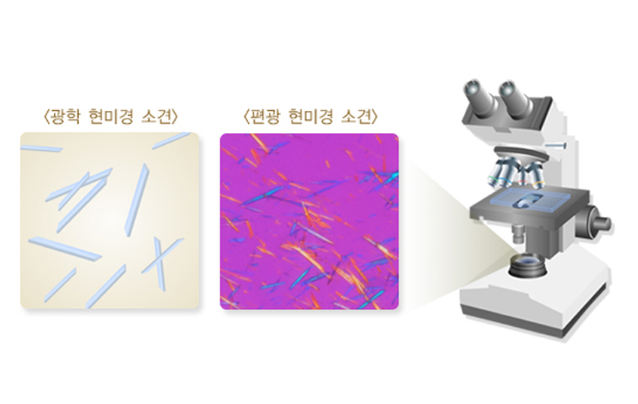 통증을 일으키는 요산 결정 (출처:국가건강정보포털)