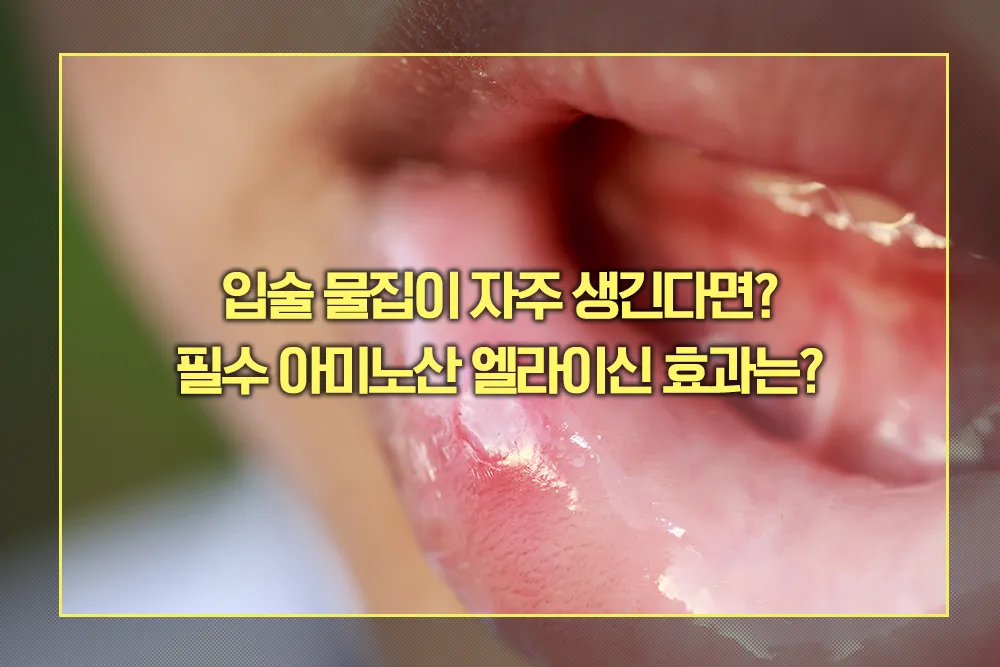 입술 물집 필수 아미노산 엘라이신 효과