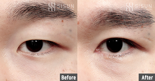 남자 눈매 교정술