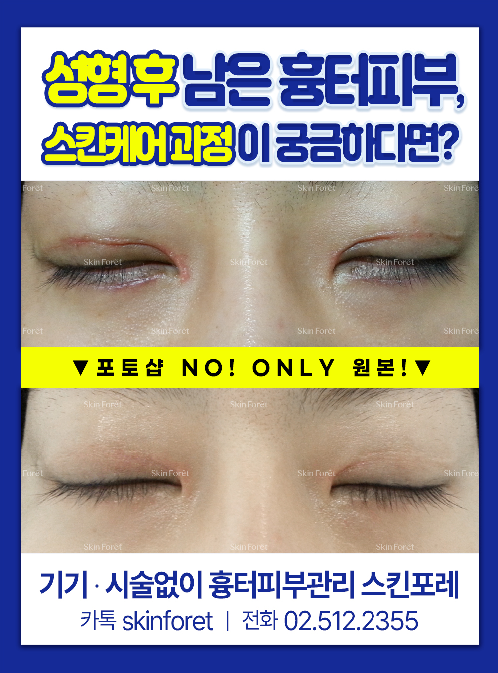 쌍꺼풀재수술 이후 눈꺼풀에 남은 흉살을 skinforet 전후로 안정감 있게 다듬은 모습
