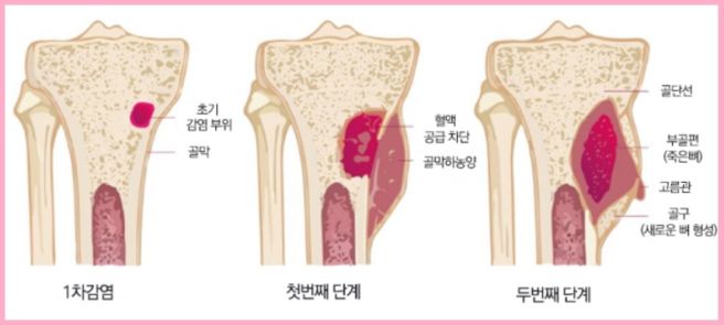 골수염 증상
