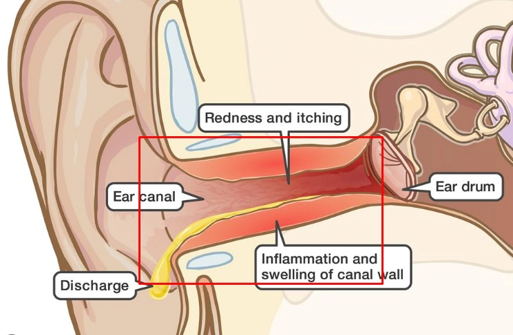 외이도염 증상 6가지 및 보청기 외이도염 통증 치료 방법