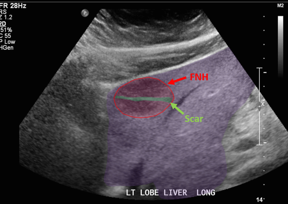 FNH (Focal Nodular hyperplasia)