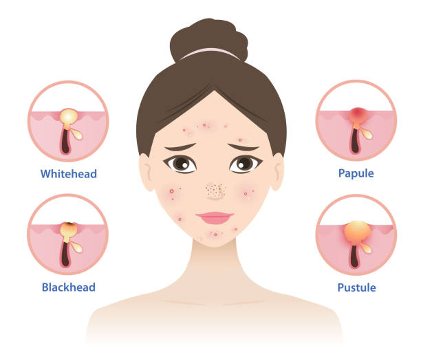 얼굴여드름이 잘 생기는 주요 부위