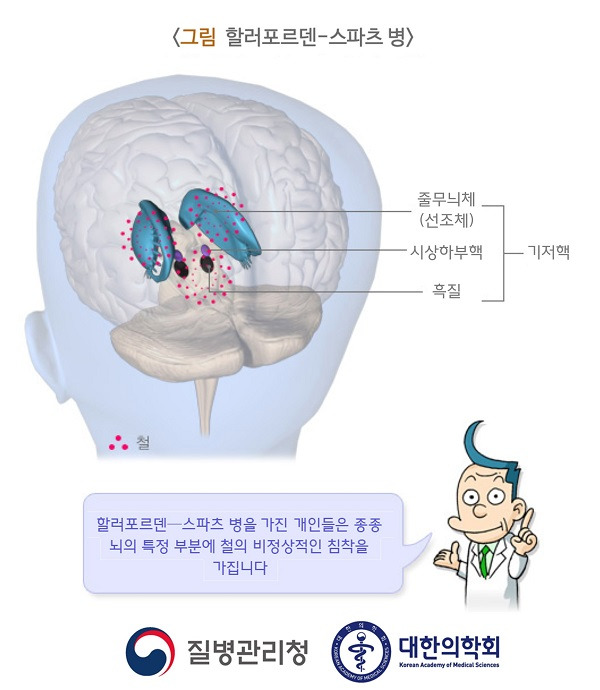 신경퇴행질환 할러포르덴-스파츠병