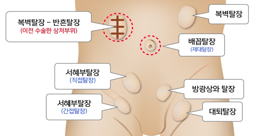 탈장 종류와 원인