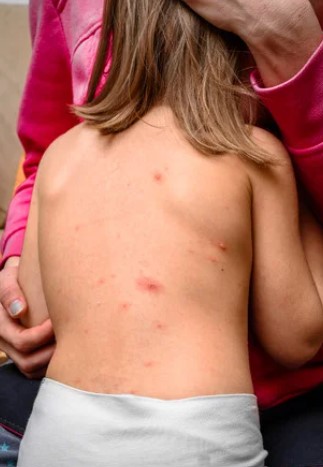 대상포진 초기증상 대상포진 조기치료 대상포진 초기증상 및 조기치료