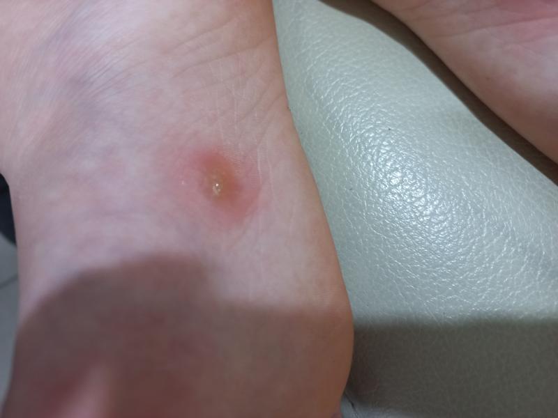 굳은살 냉동치료 1주차 치료 직후