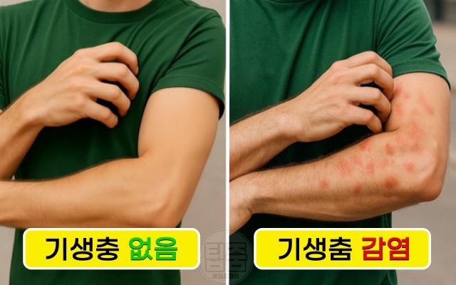 기생충 감염 증상 가려움 각질 물집 옴진드기