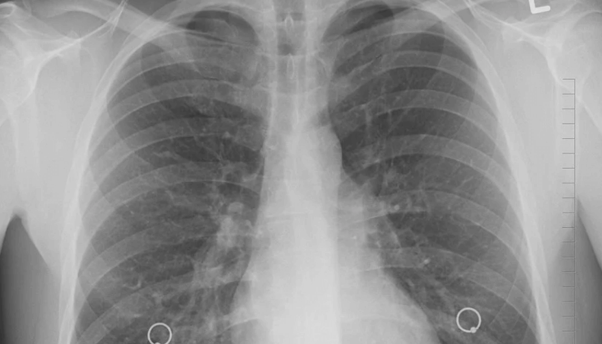 엑스레이 촬영 사진이 가슴 부위를 찍은 모습