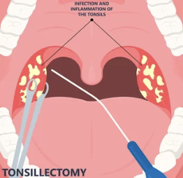 집에서 편도결석 제거하는 방법