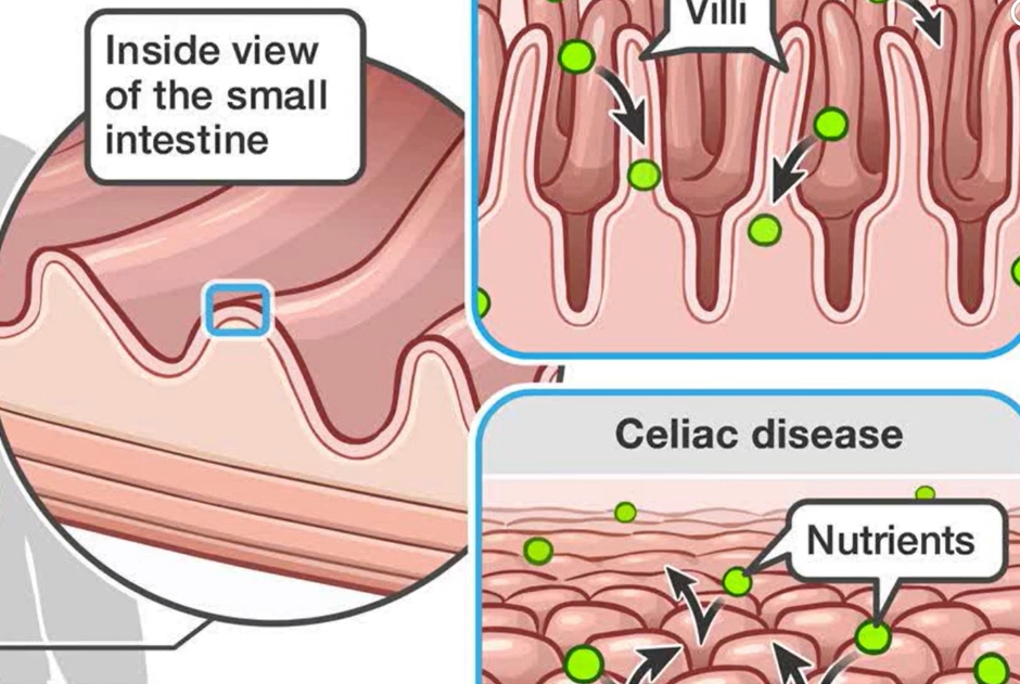 방귀 냄새가 지독해요