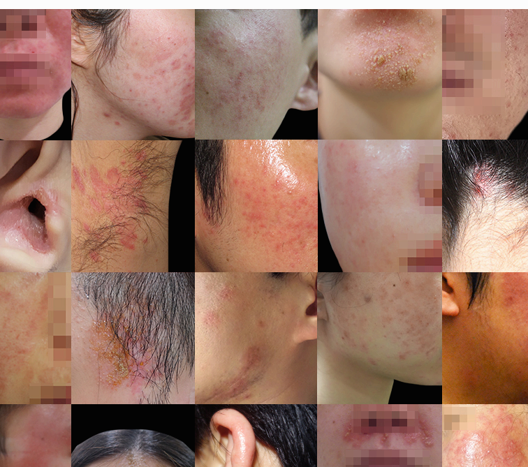 피부 지루성피부염