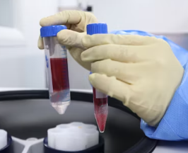 빈혈 증상 원인 치료 방법