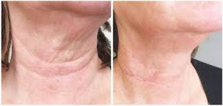 목주름 없애는 비결