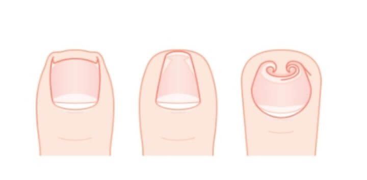 내성발톱 자가치료