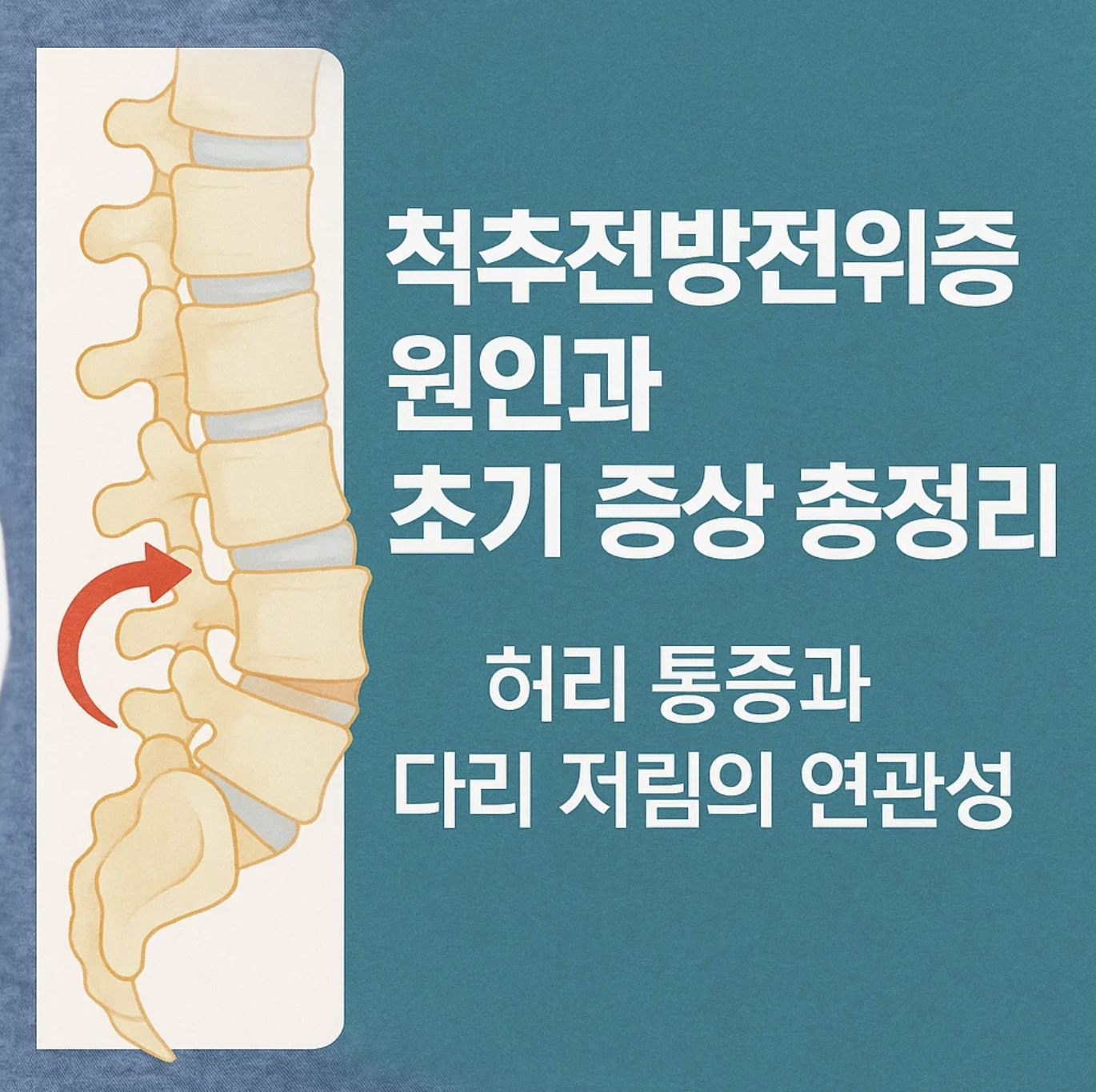 척추전방전위증 원인과 초기 증상 총정리, 허리 통증과 다리 저림의 연관성