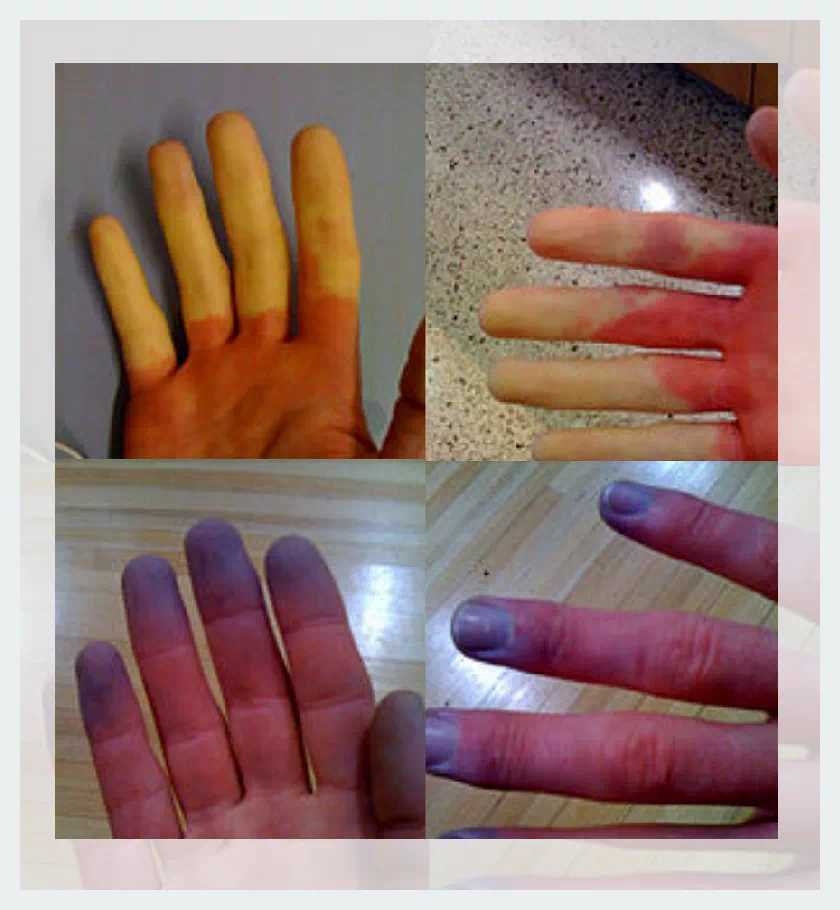 손 레이노이드증후군