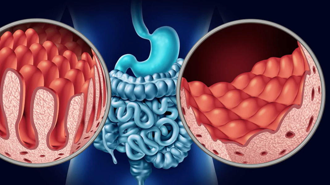 방귀 냄새가 지독해요