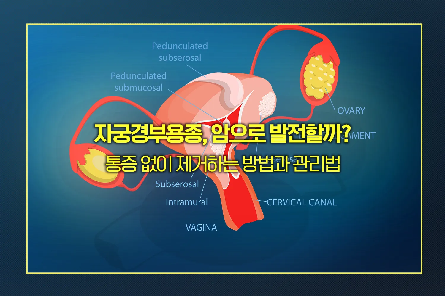 자궁경부용종-암위험-제거관리