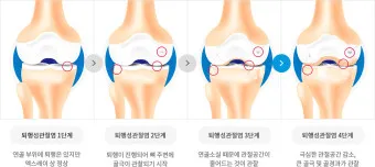 관절염에 좋은 음식 TOP 10_3