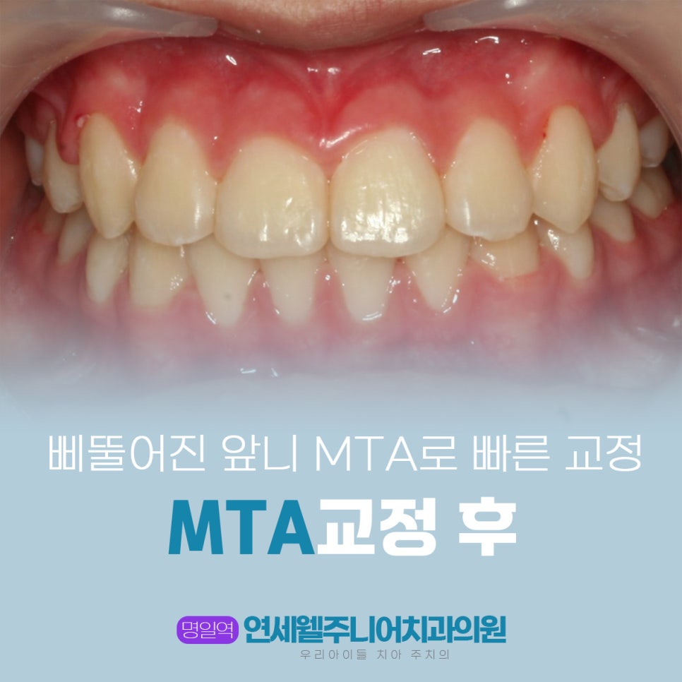 어린이 MTA 교정 후 가지런하게 개선된 앞니 모습
