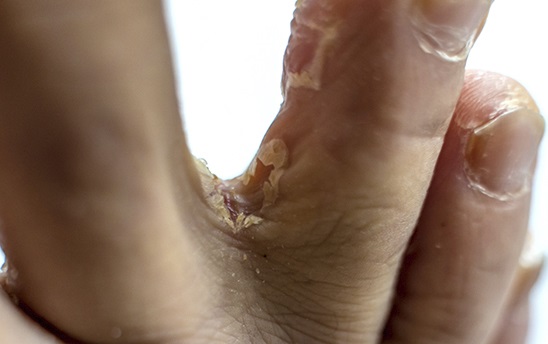 발가락 사이 무좀이 발현된 사진
