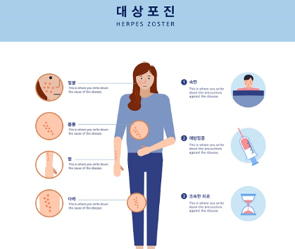 대상포진예방접종&amp;#44; 백신종류 비용