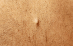 남자, 여자 생식기 피지낭종, 원인, 제거 수술 비용