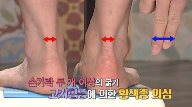 건황색종