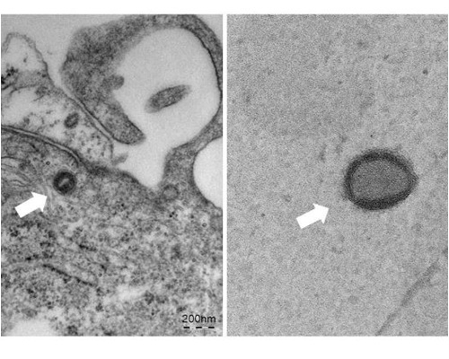 엠폭스 증상 및 원인