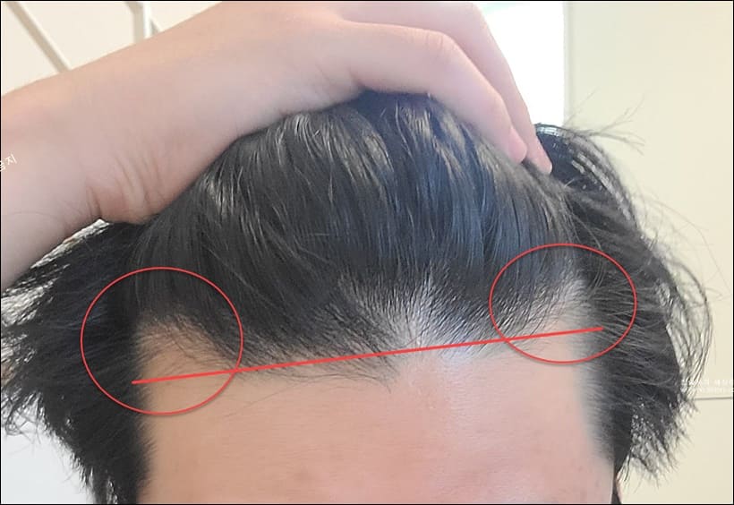 선천적 m자 이마