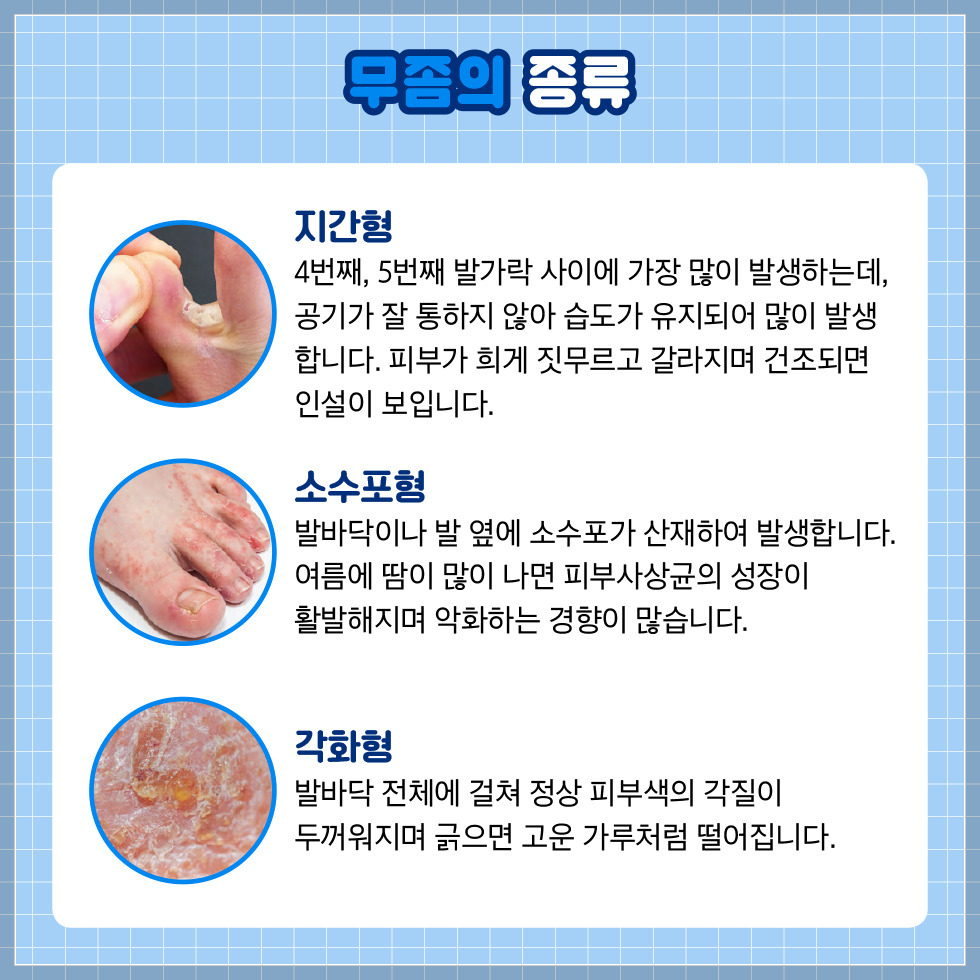 발무좀종류