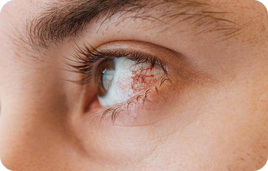 안구-건조증-치료