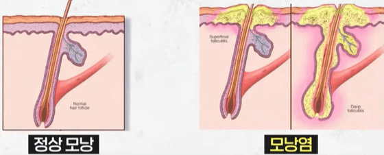 세균 감염으로 인한 모낭염
