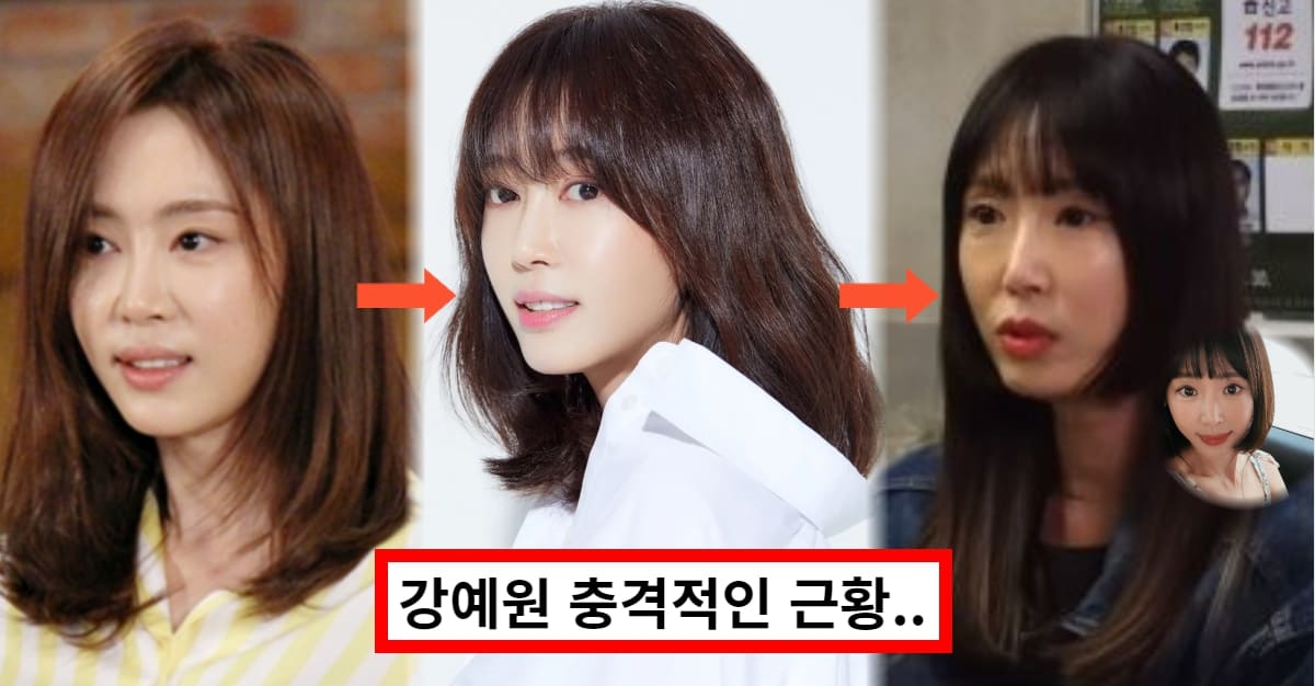 강예원 &#39;앞트임 복원&#39; 성형 후 충격적인 변화에 상처받아..