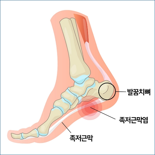 족저근막염